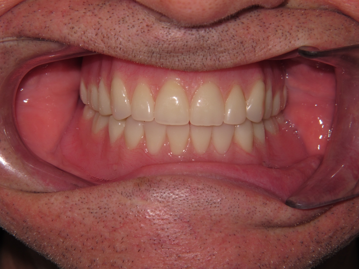 Dentures Smile Gallery Raber Dental Kidron Dentist