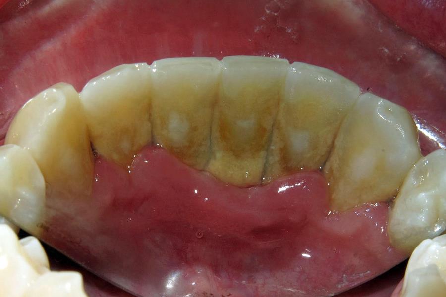 Gum Disease - Raber Dental, Kidron Dentist